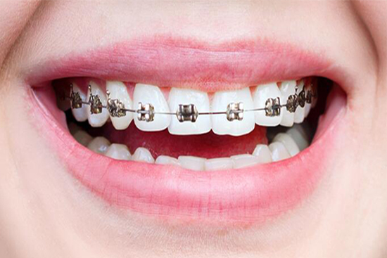 Orthodontic Treatment