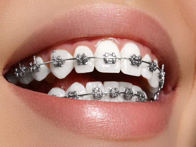 Orthodontic Treatment