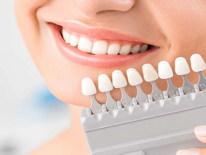 Porcelain Veneers