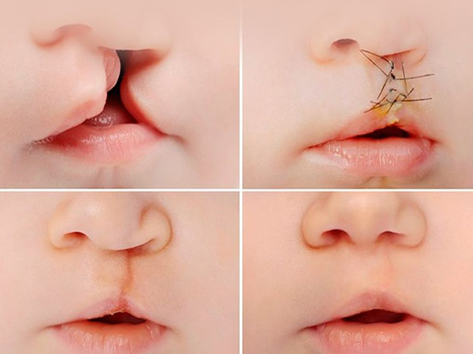 Cleft Lip and Cleft Palate