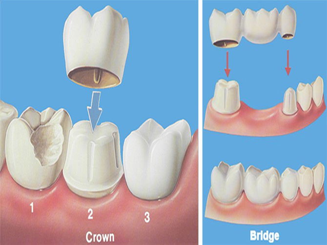 Crown & Bridge