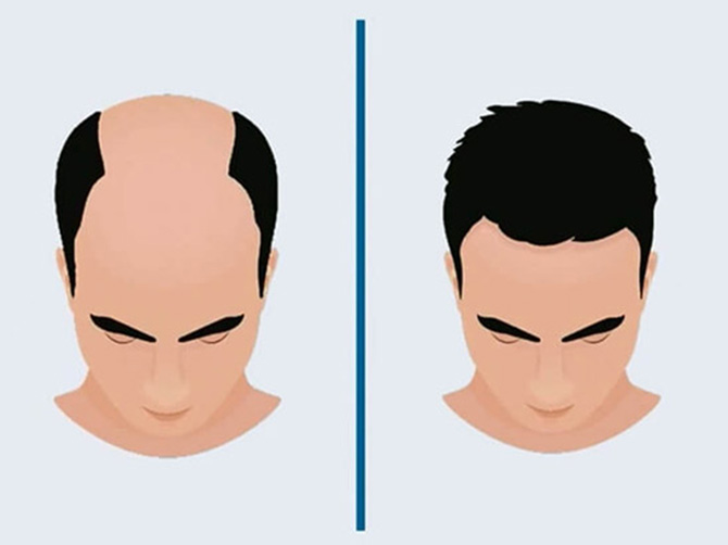 Hair Transplant