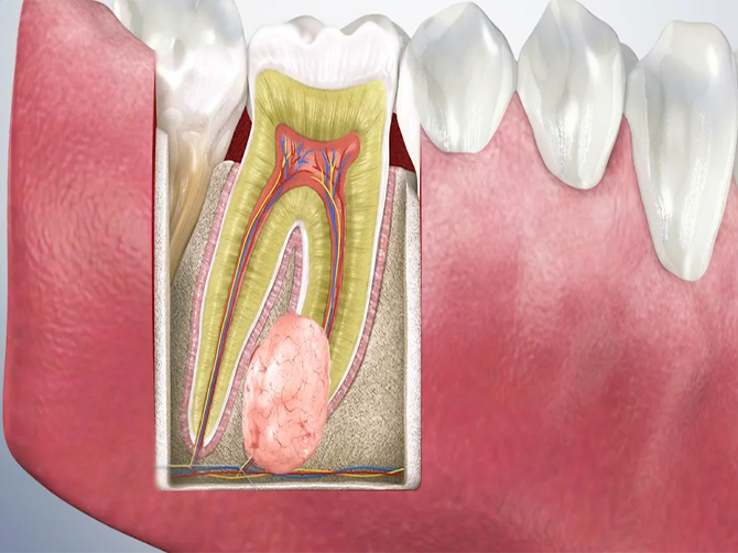 Tumor-Cyst Removal