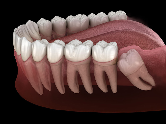 Wisdom Teeth Surgery